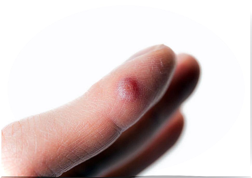 5 solutions to remove warts on fingers