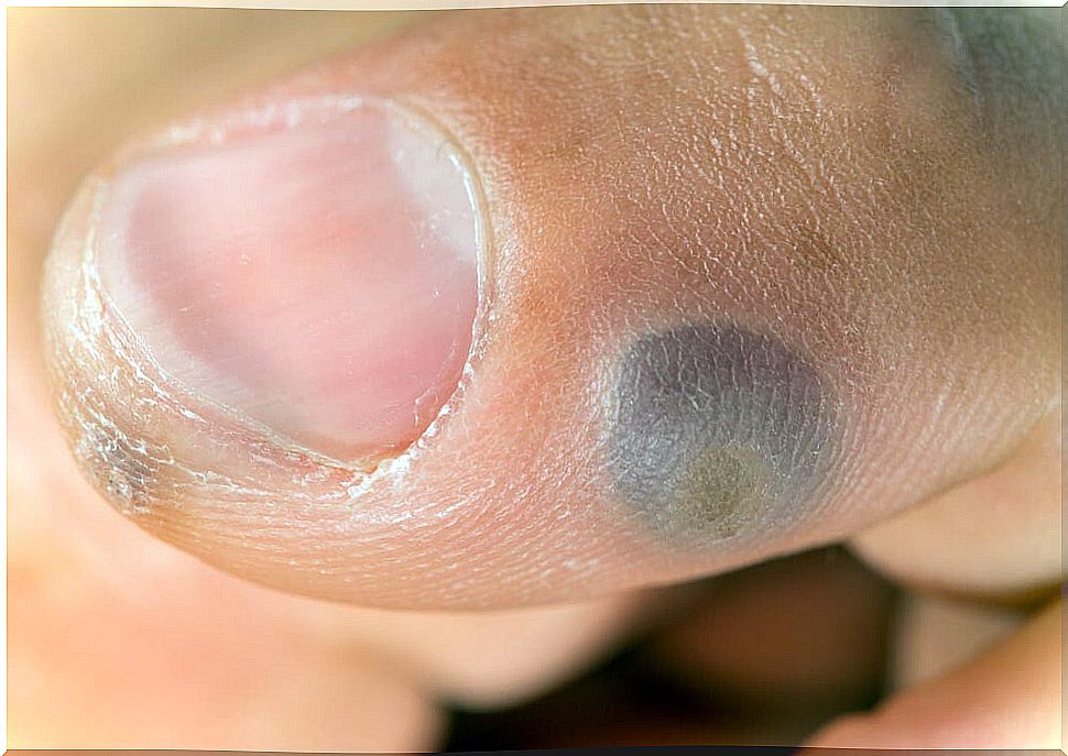 Frostbite of the wart on a finger.