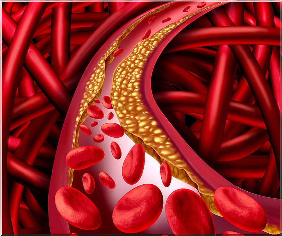 Hypercholesterolemia