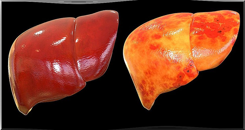 Healthy liver and fatty liver.