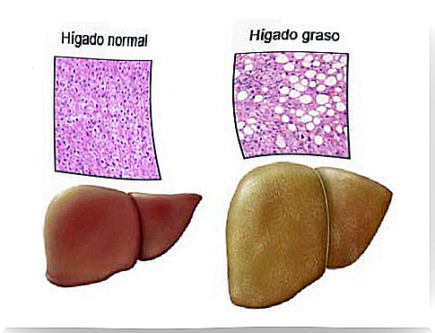 Fatty liver