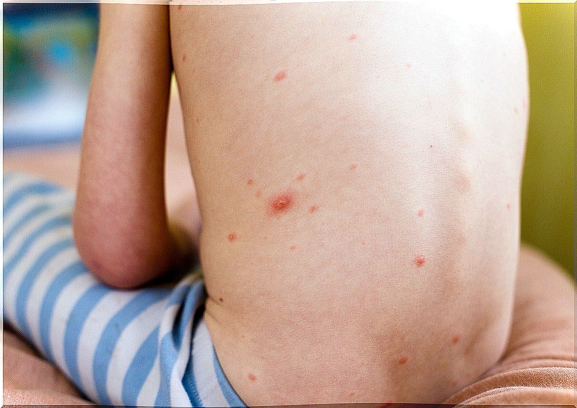 Causes of atopic dermatitis