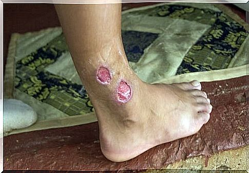 Contagious cutaneous vector leishmaniasis