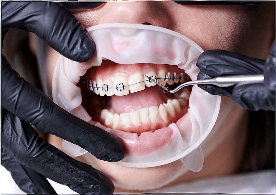 Types of orthodontics for older adults.