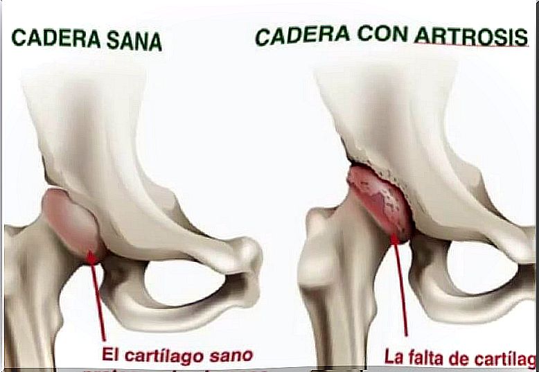 hip arthrosis