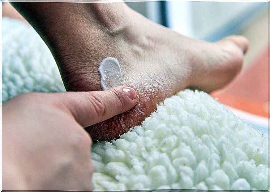 Remedies and tips to end cracked heels in a few days