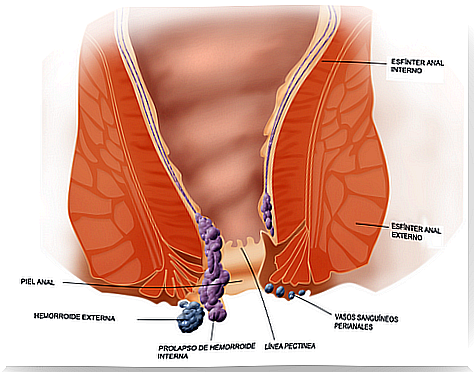 diagram of the rectum showing hemorrhoids